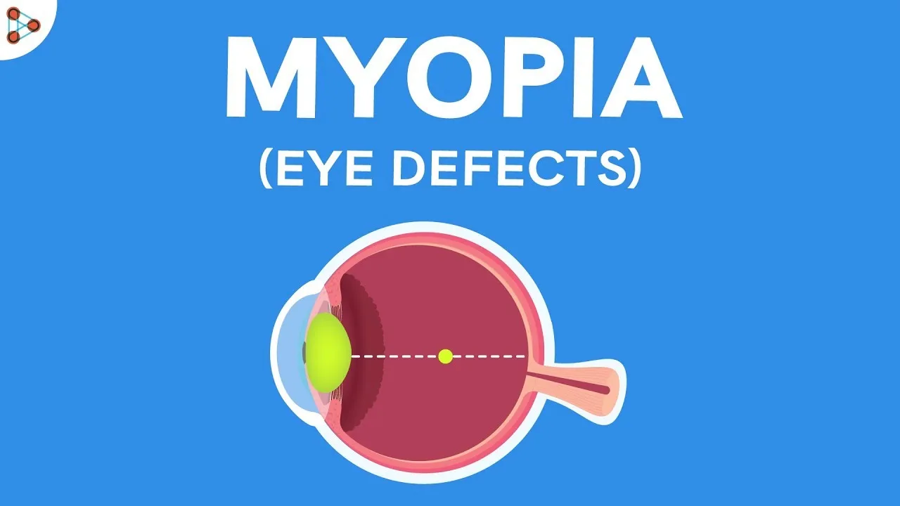 Illustration of Myopia: Blurred vision of distant objects due to elongated eyeball or overly curved cornea. Nearsightedness condition explained."