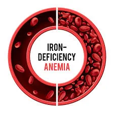 Exploring Iron Deficiency Anemia: Causes, Diagnosis, and Treatment"