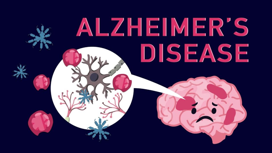 Memory Lost: Understanding the Warning Signs of Alzheimer's Disease