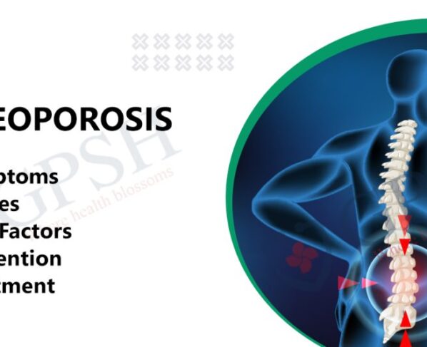 7 Risk Factors for Osteoporosis: Protecting Your Bones