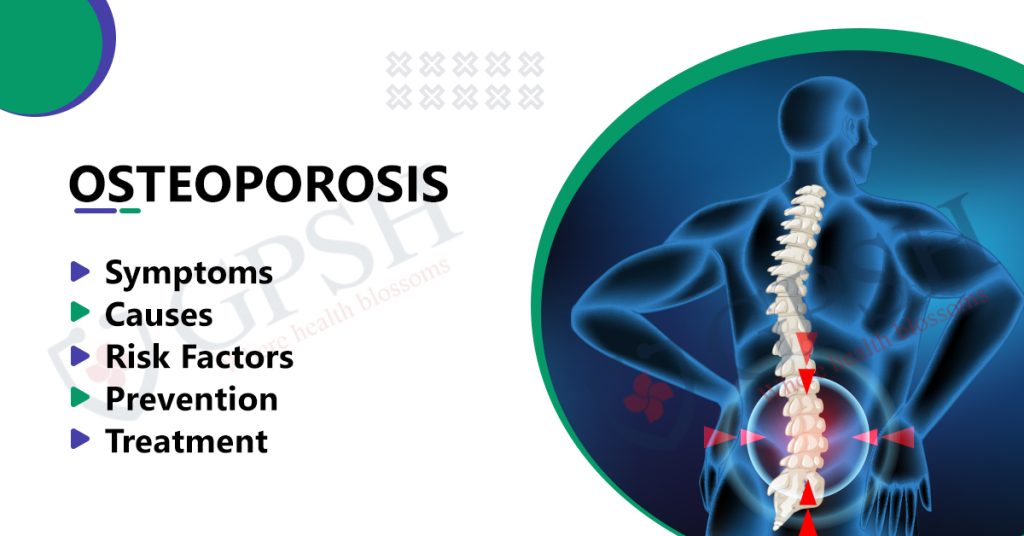 7 Risk Factors for Osteoporosis: Protecting Your Bones