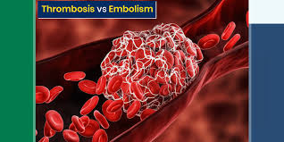 Thrombosis vs. Embolism: Demystifying Blood Clots and Their Differences