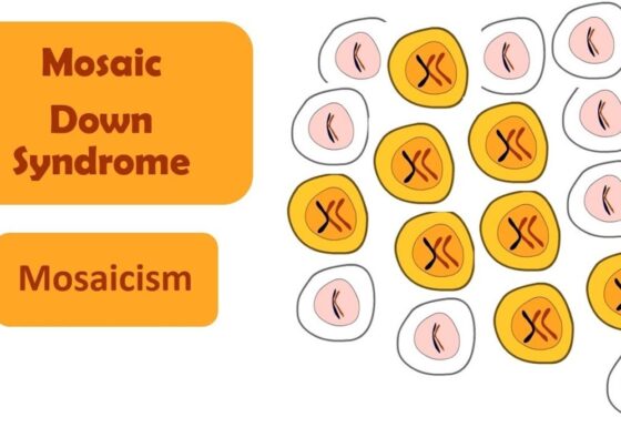 Unlocking Uniqueness: Mosaic Down Syndrome Symptoms Explored