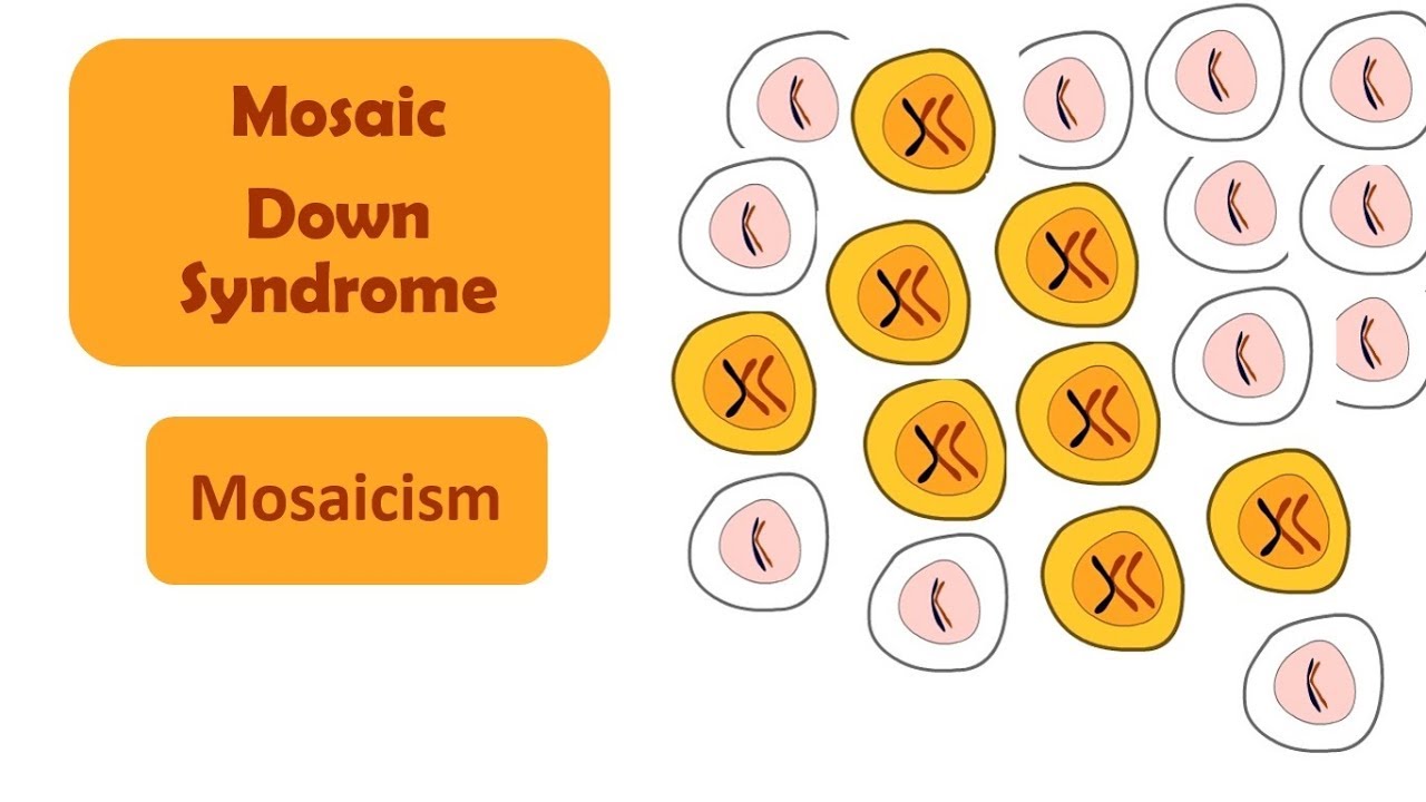 Unlocking Uniqueness: Mosaic Down Syndrome Symptoms Explored