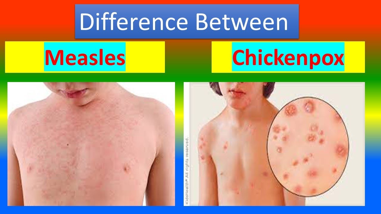 Chickenpox vs Measles